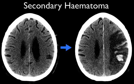 Hemorrahgic transormation 또는 hemorrhagic infarction CT MRI image
