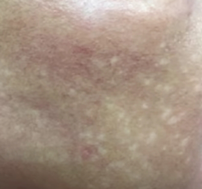 저색소-현상-이미지