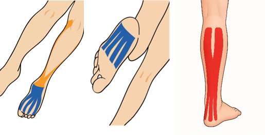 다리 피로(종아리)의 근육 테이핑 요법