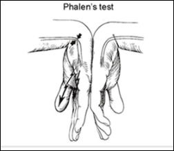 손목터널증후군 증상 -5