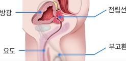 전립선비대증 치료와 좋은음식 총정리