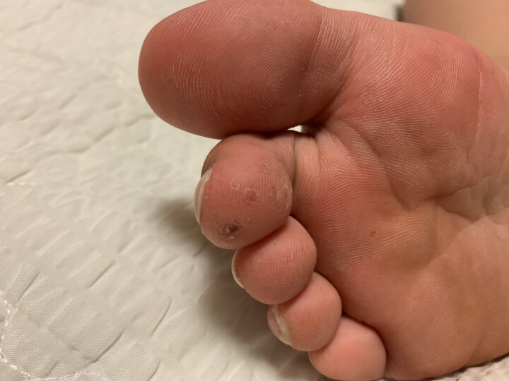 왼쪽-사진은-하나-남은-족저-사마귀-오른쪽은-말끔해진-발가락