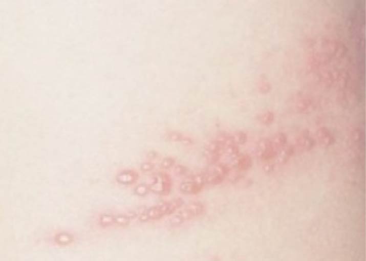 대상포진 초기증상