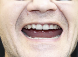 임플란트 종류가격차이점