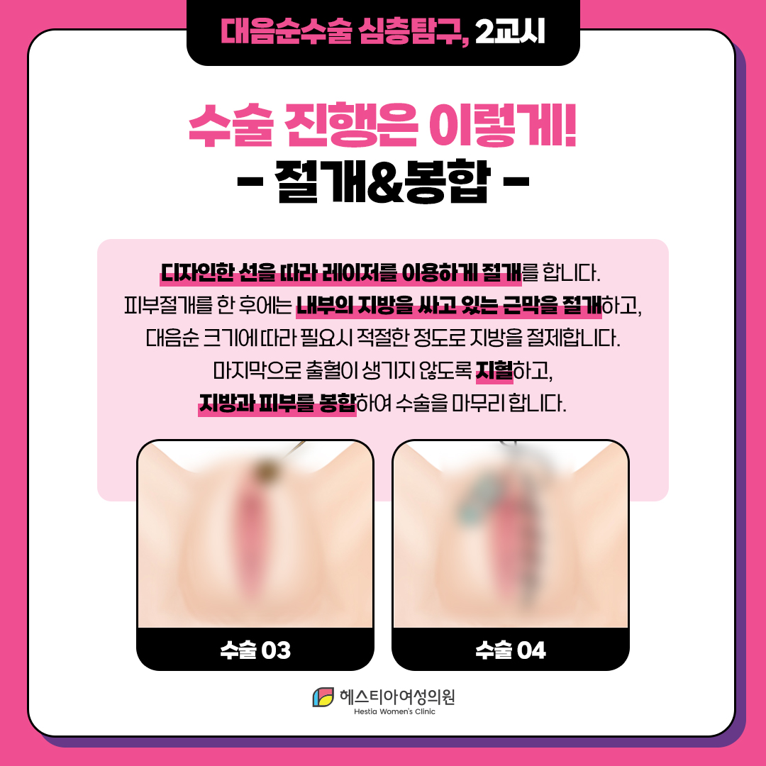 대음순성형수술 
수술 진행사항 
절개&봉합