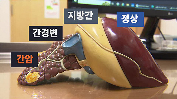 술과 지방간의 관계