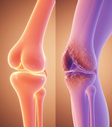 콘드로이친 효능 : 연골 손상 방지&amp;#44; 염증 감소 효과