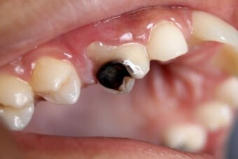 치아보험으로-이빨이-썩어-검게-변하는-이를-치료하는-모습