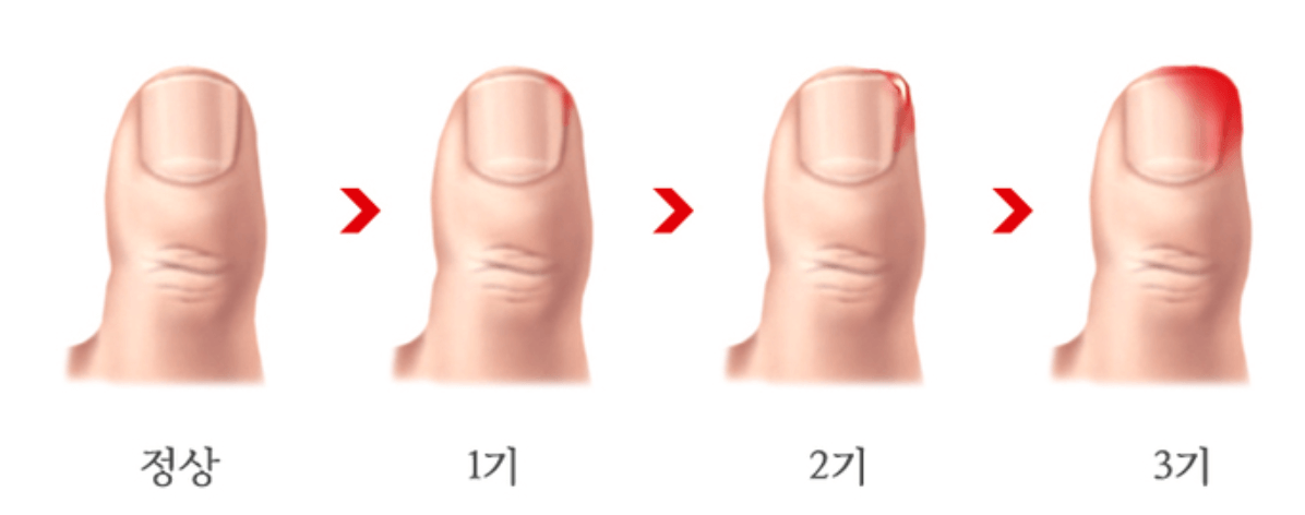 내성발톱