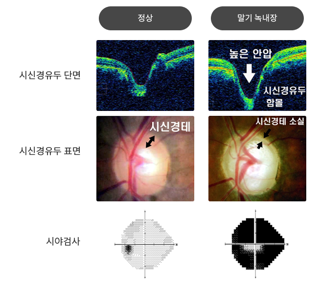 녹내장 고위험군
