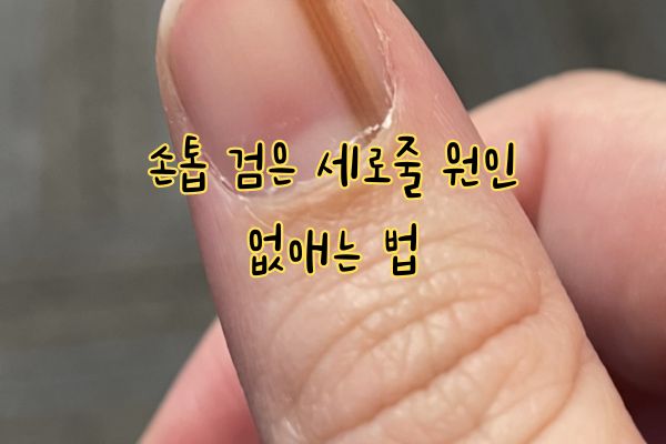 손톱 검은 세로줄 원인 없애는 법