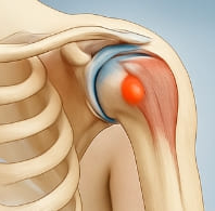 어깨 석회질 치료방법