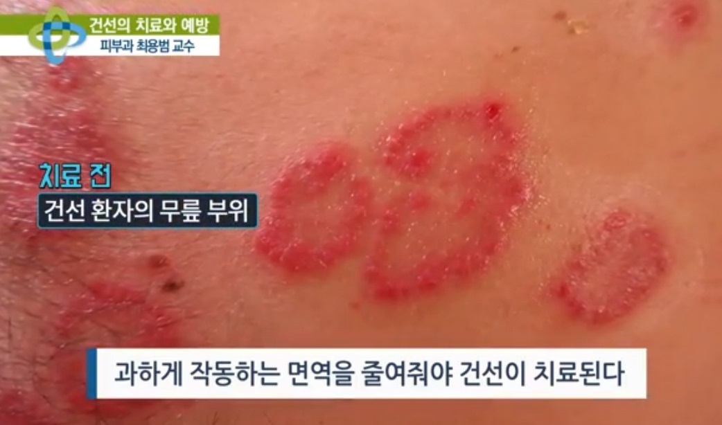 최용범-교수-대상포진-건선-두드러기-아토피