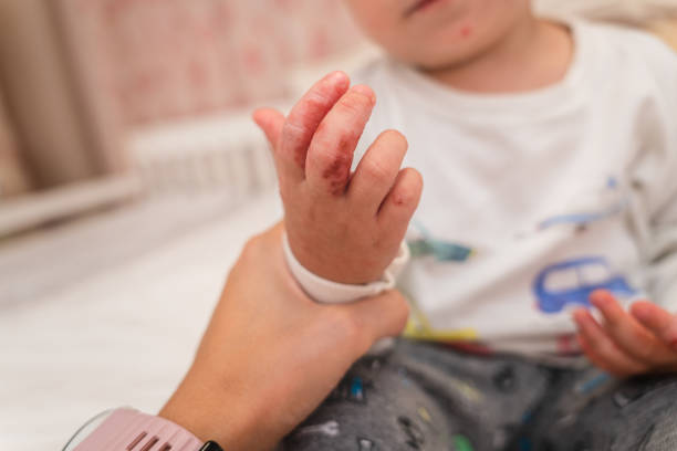 수족구 증상과 원인&amp;#44; 치료