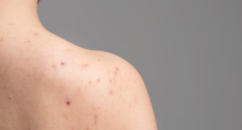 아토피 피부염의 원인