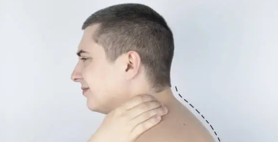 일자목 증후군과 관련된 사진