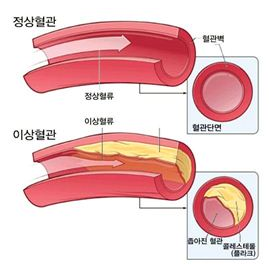 고지혈증에 좋은 음식
