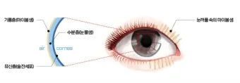 눈물이 자주 나는 이유에 대한 안과정보_24
