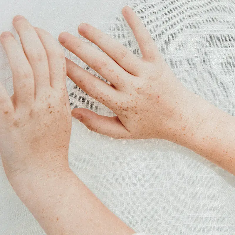 중년 여성 피부장벽 무너질 때 생기는 기미&middot;잡티&amp;#44; 이렇게 회복하세요