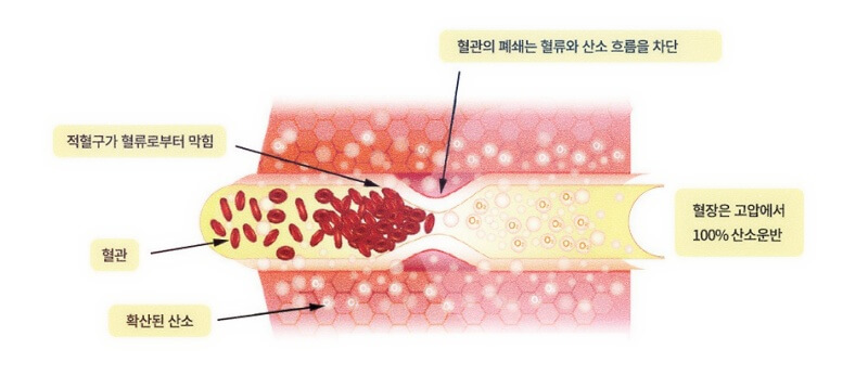 고압산소치료기기