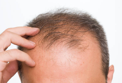 남성 탈모
