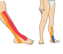 발목 통증(류마티스성 원인)