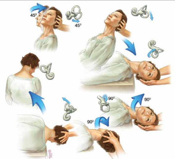 이석증 자가 치료 자세