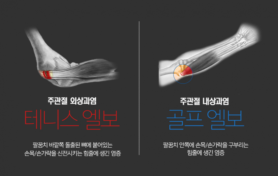 "테니스 엘보" 치료법, 자가 치료 운동
