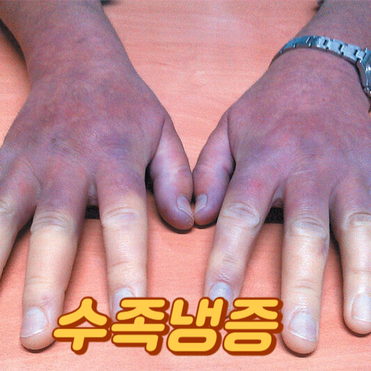 수족냉증