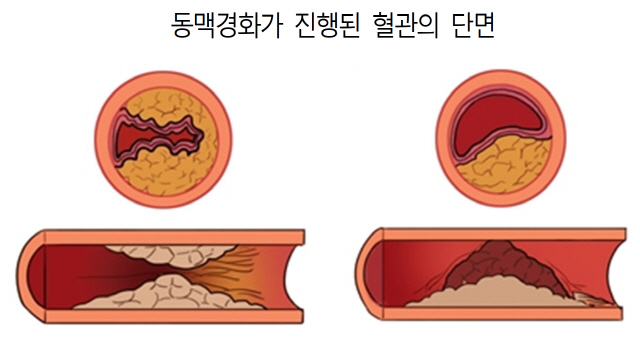 동맥경화