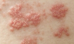 대상포진 환자의 수포 발진