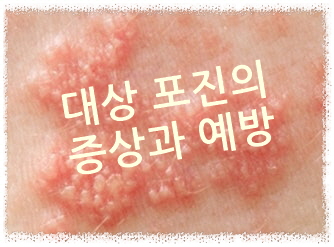 대상 포진의 수포 발생