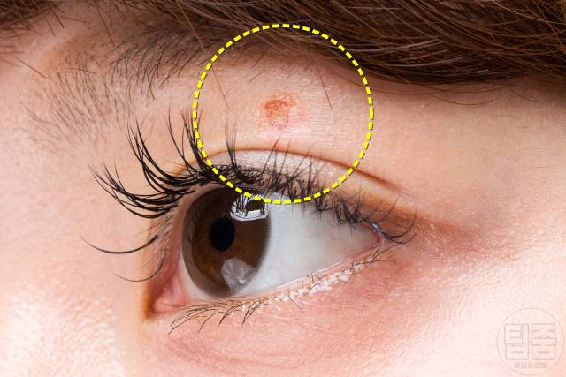 피부암 호발 부위 피부암자가진단 눈꺼풀