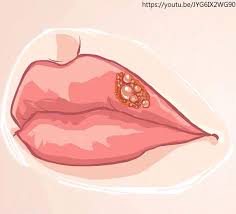 입술 포진 빨리 낫는법