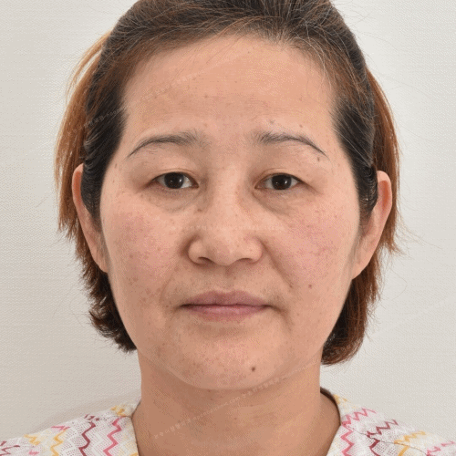 눈꺼풀처짐