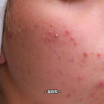 여드름 빨리없애는 방법
