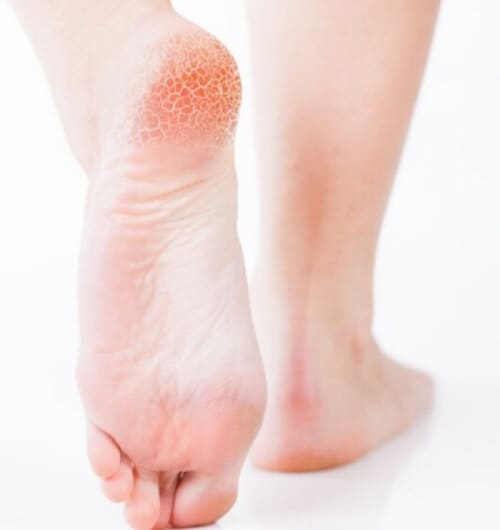 발뒤꿈치가-갈라지는-이유