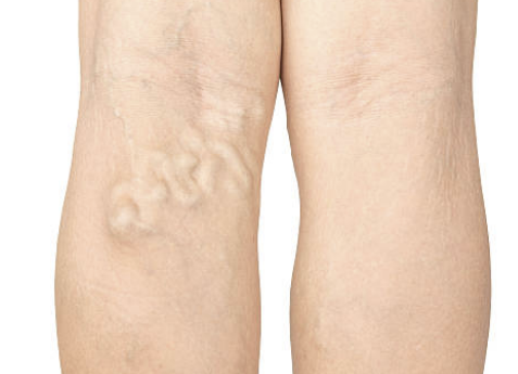 하지정맥류 증상 수술비용 좋은운동 등 총정리(2024 최신)