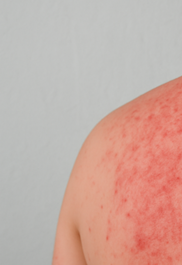 땀띠 가라앉히는 방법