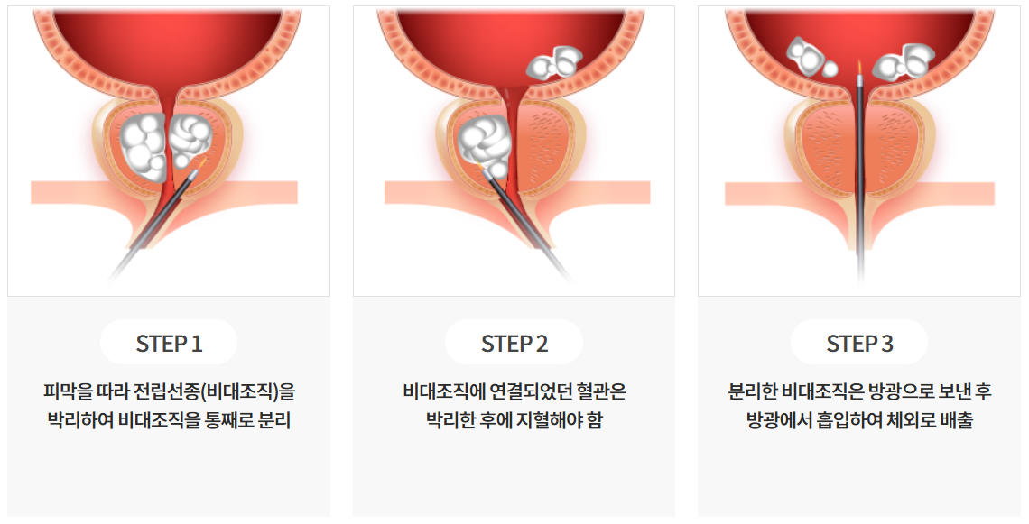 홀랩수술