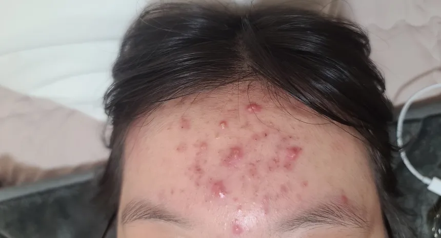 여드름 빨리 없애는 법