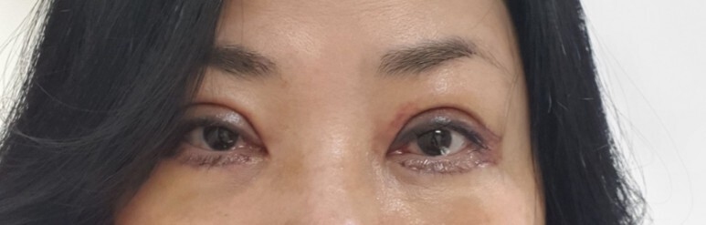 하안검 수술 후기