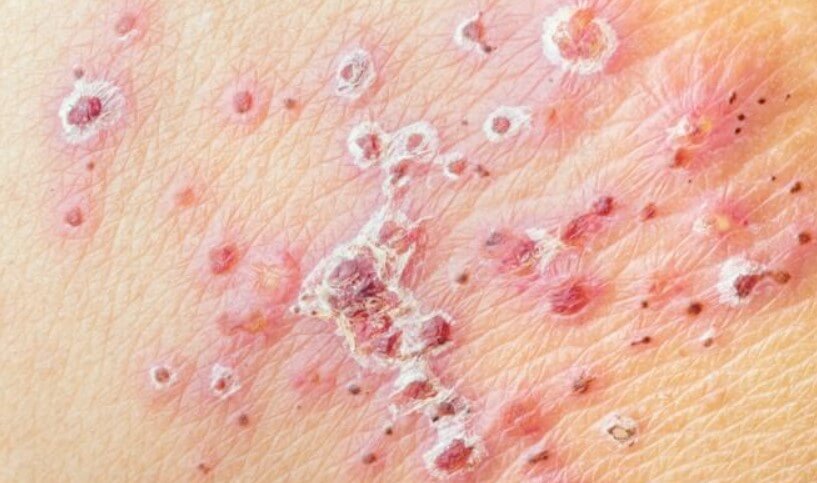 대상포진 초기증상 대상포진 조기치료 대상포진 초기증상 및 조기치료