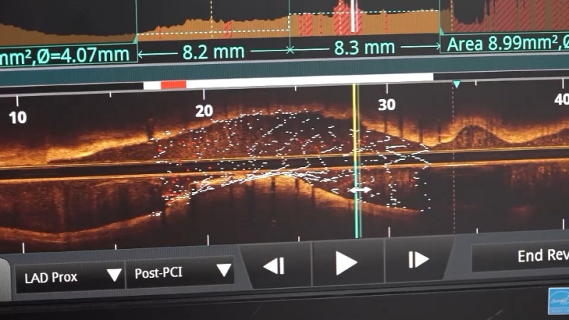 몀의 심혈관 질환