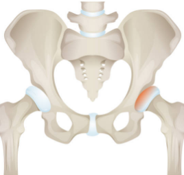 고관절 통증 증상, 통증 원인, 수술 총정리 (2024ver)