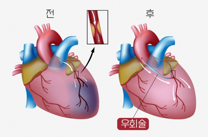 관상동맥우회술-수술-과정-소요-시간-비용-(+스탠트-시술과의-차이점)