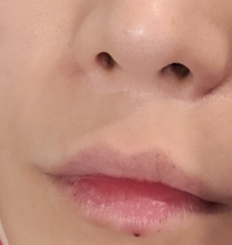 인중 축소 수술 후기