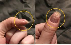 손톱이 울퉁불퉁해지는 원인과 관리법
