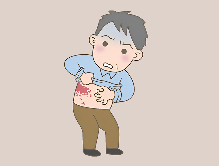 수두-대상포진 바이러스의 재활성화