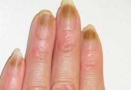 손톱이 노랗게 변하는 이유와 질환 가능성